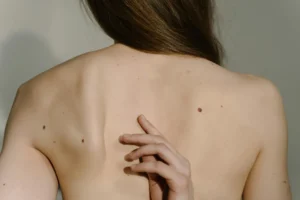 ¡Cuidado con tus lunares! Sus cambios pueden representar algún riesgo