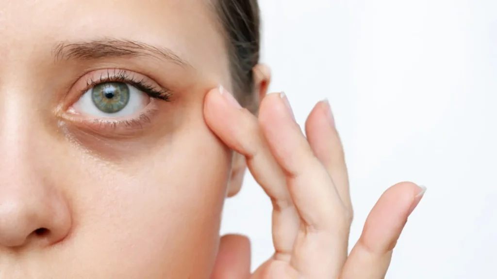 Las ojeras pueden aparecer por múltiples factores, desde genética y pigmentación hasta estrés, circulación y cambios naturales en la piel. Foto: Doctología.