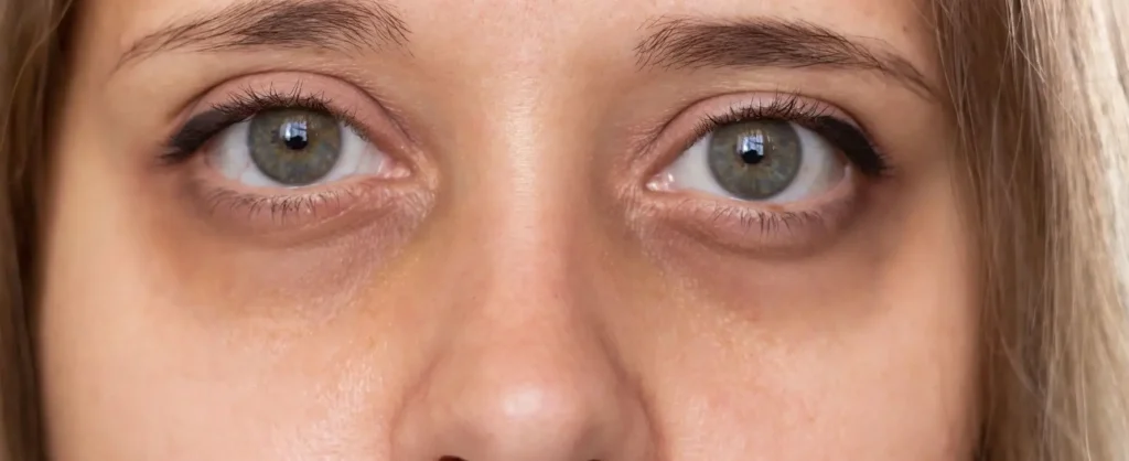 Ojeras: por qué algunas personas las tienen incluso descansando 1 Ojeras: por qué algunas personas las tienen incluso descansando